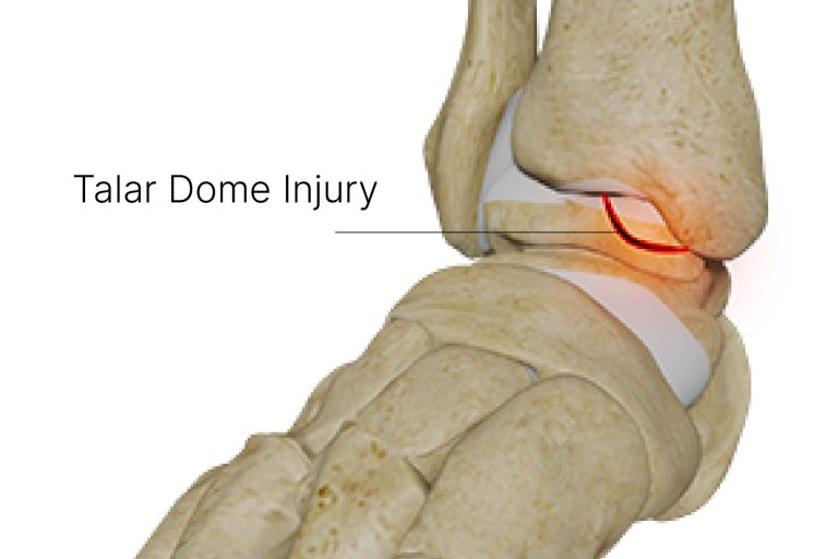 Talar Dome Injury Management The Foot Practice Singapore