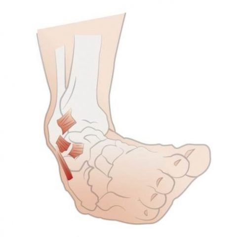 Ankle Sprains Treatment | The Foot Practice Singapore