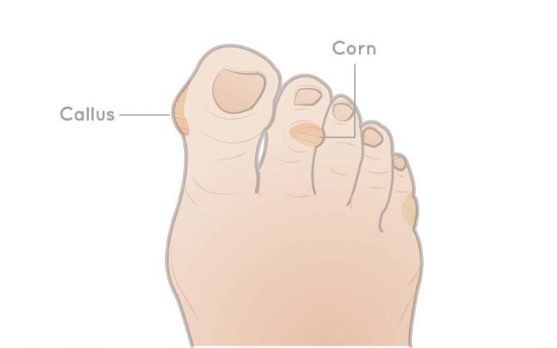 difference between corn and callus