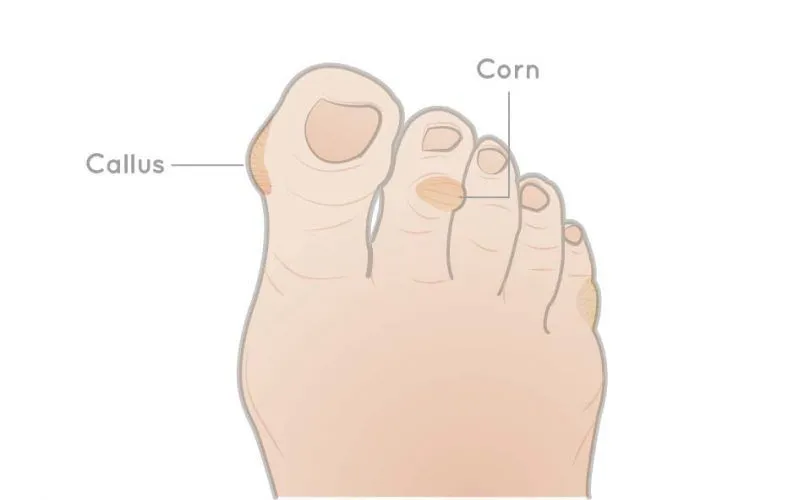 Foot Corn Treatment & Callus Removal for the Elderly