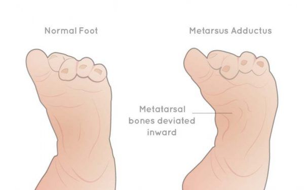 Managing Pigeon Toe Gait | The Foot Practice Podiatry in Singapore