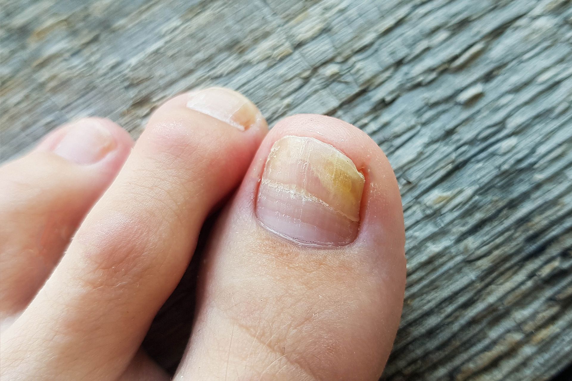 Before and after Successful Treatment for a Onychomycosis or Fungal Nail  Infection on Damaged Nails after Gel Polish Stock Photo - Image of disease,  medical: 216597144