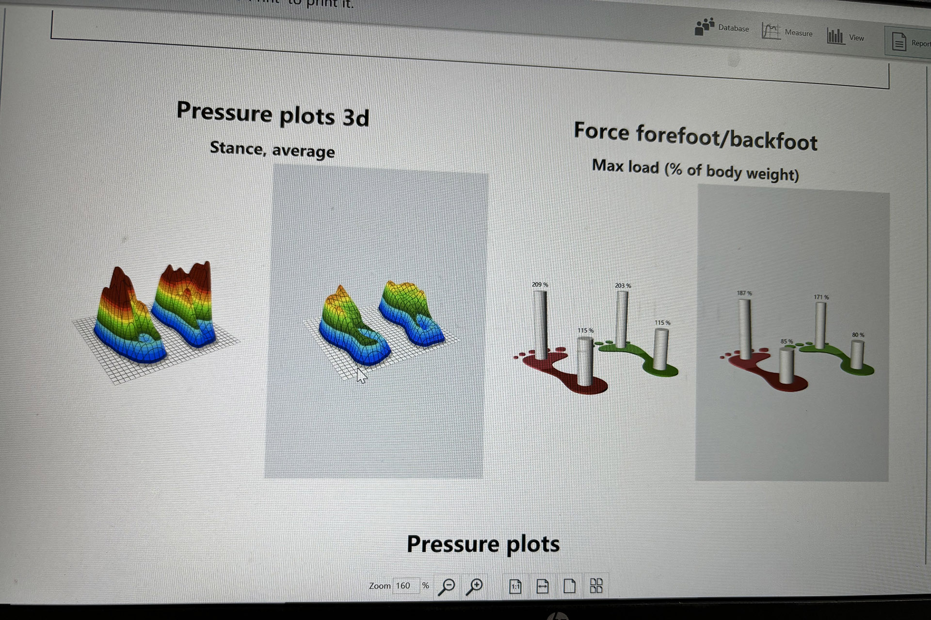 3d gait analysis for children with juvenile bunion