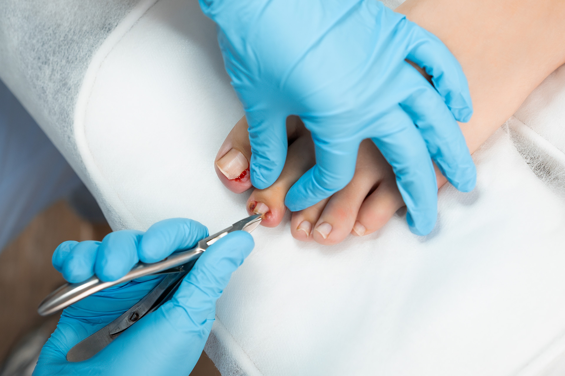 ingrown toenail surgery