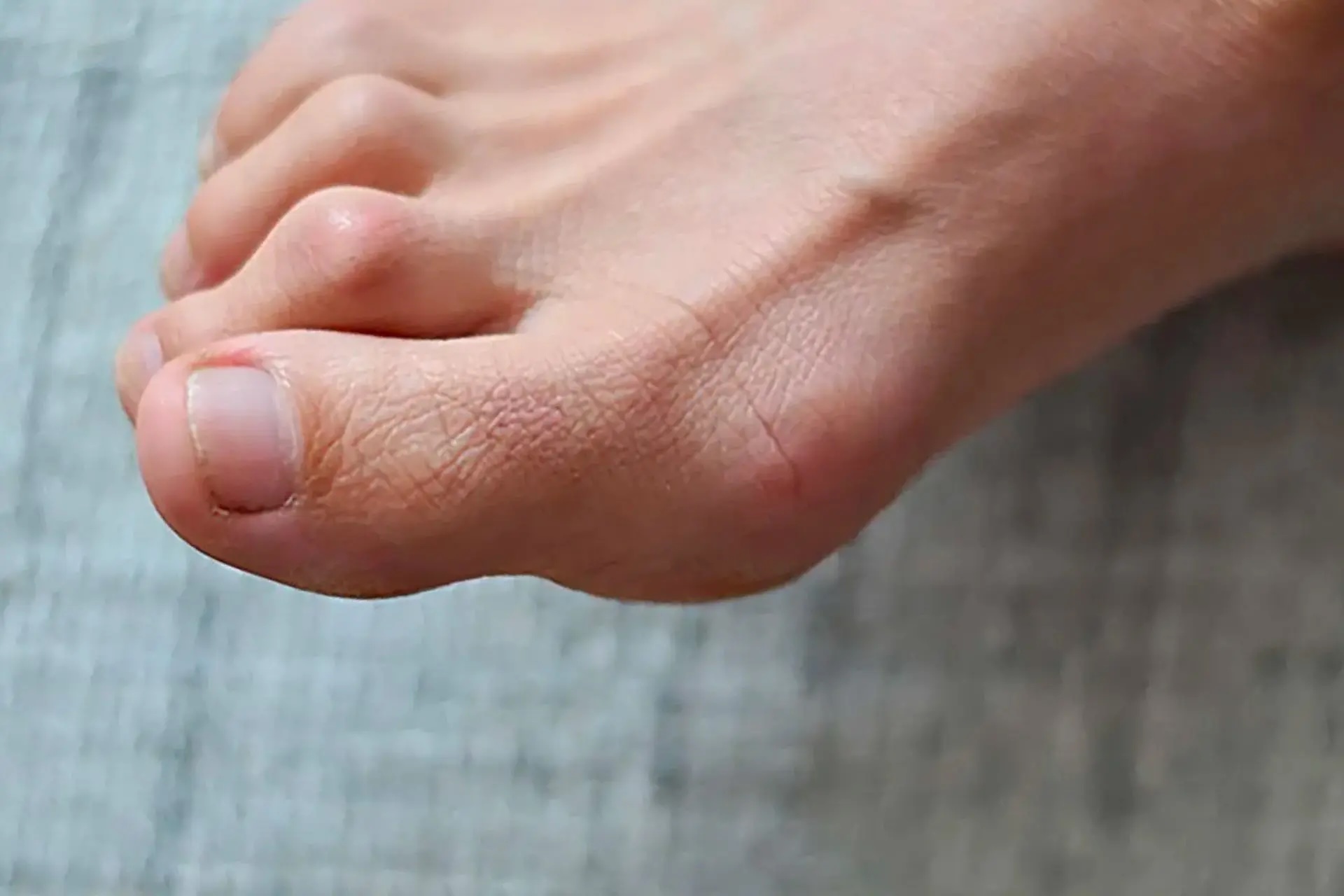 Morton's toe conditions