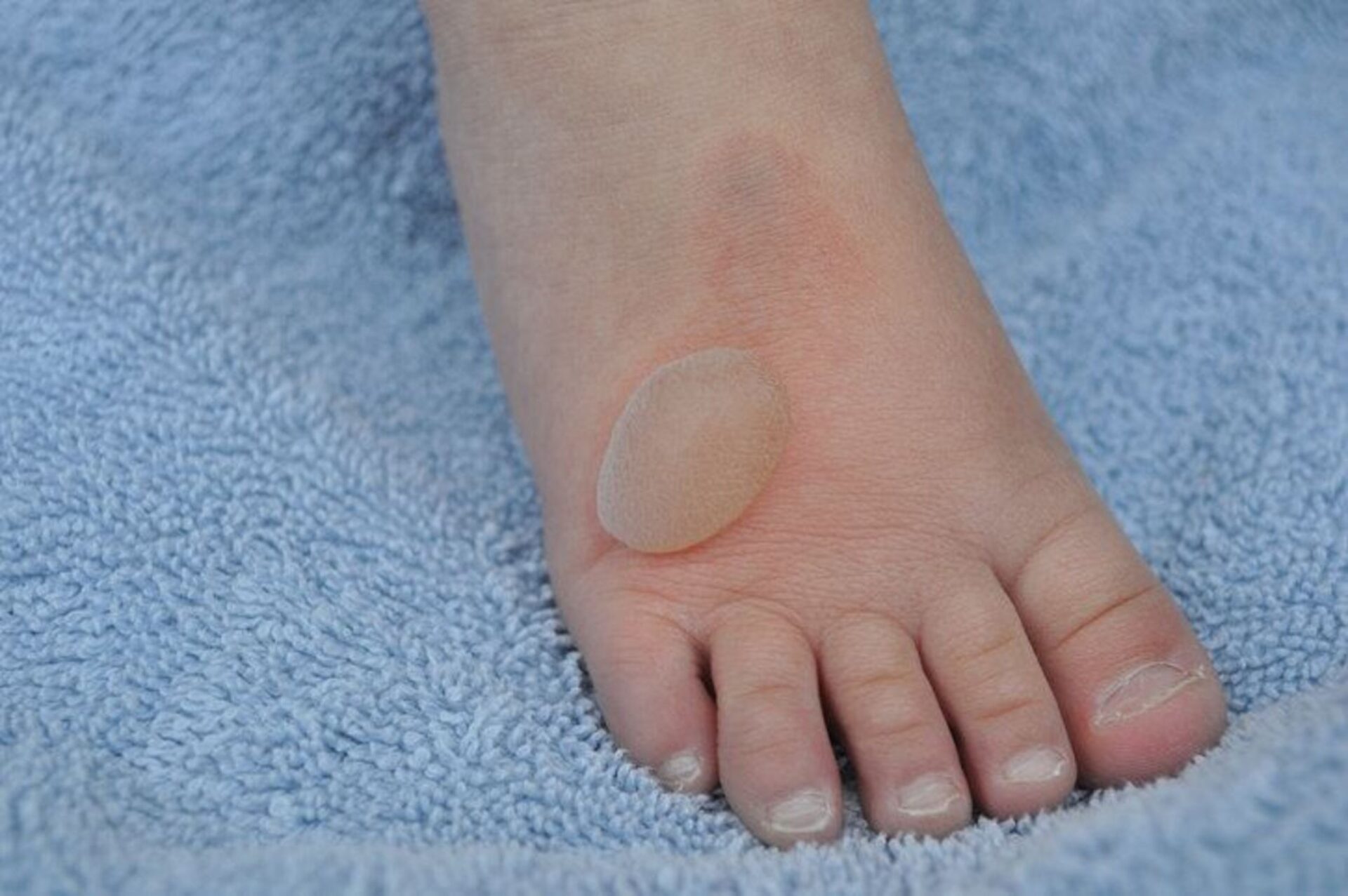 Paediatric Foot Blisters in kids