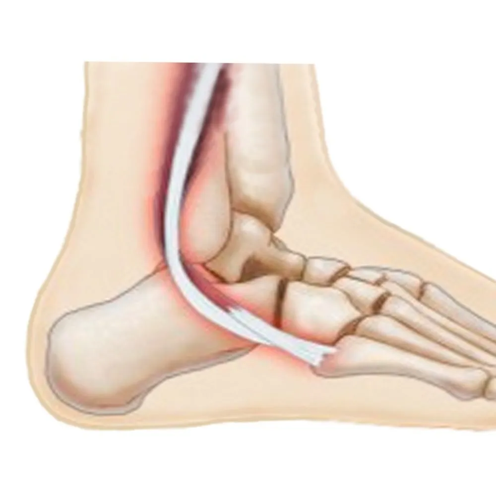 Peroneal Tendonitis  Peroneal Injury Treatment at The Foot Practice
