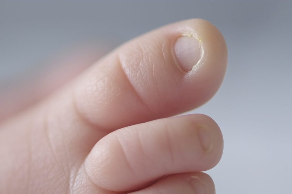 Manage Ingrown Toenails in Children and Babies through Podiatry