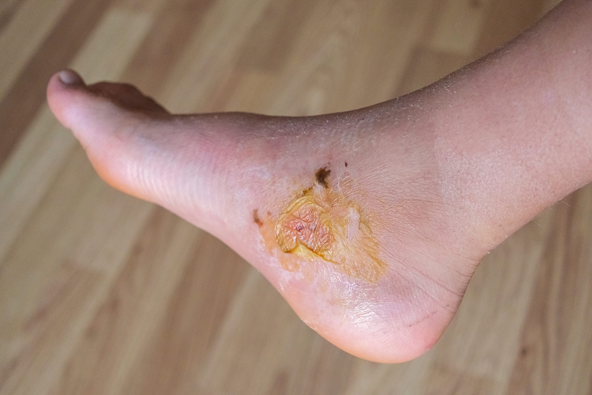 blister inside foot