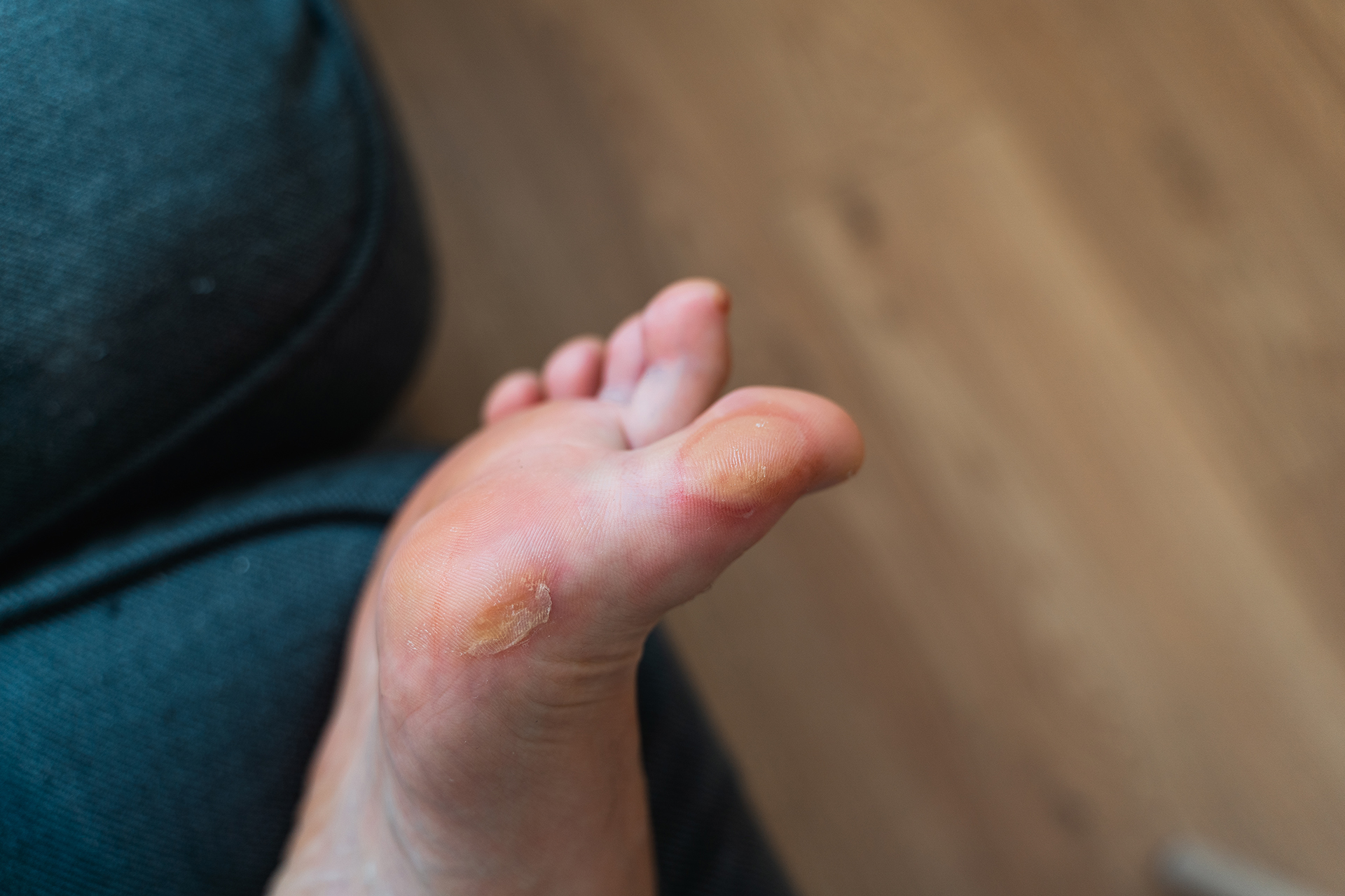 blister on foot