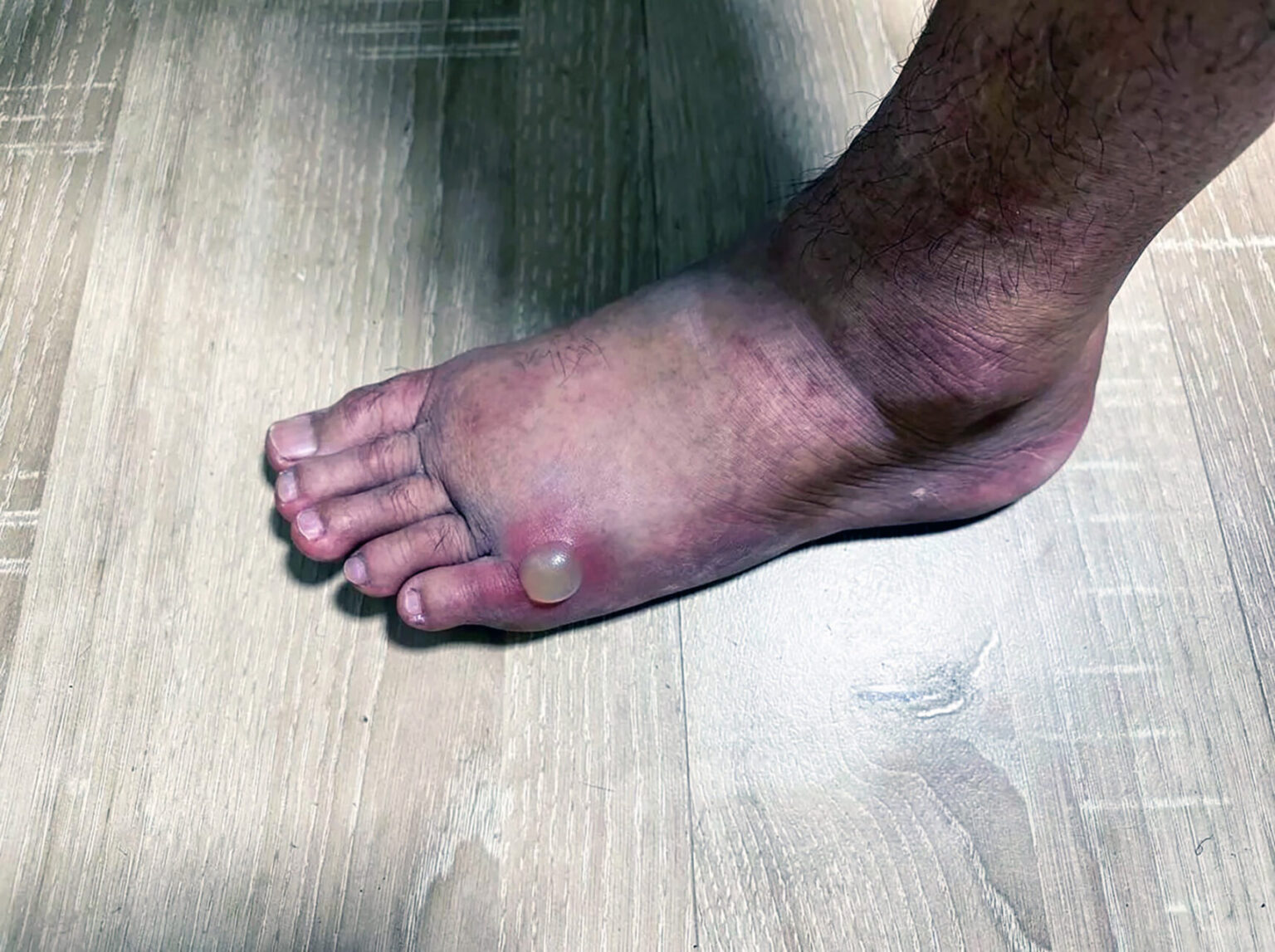 Diabetic Foot Blisters: Causes, Risks and Diabetic Foot Care in Singapore