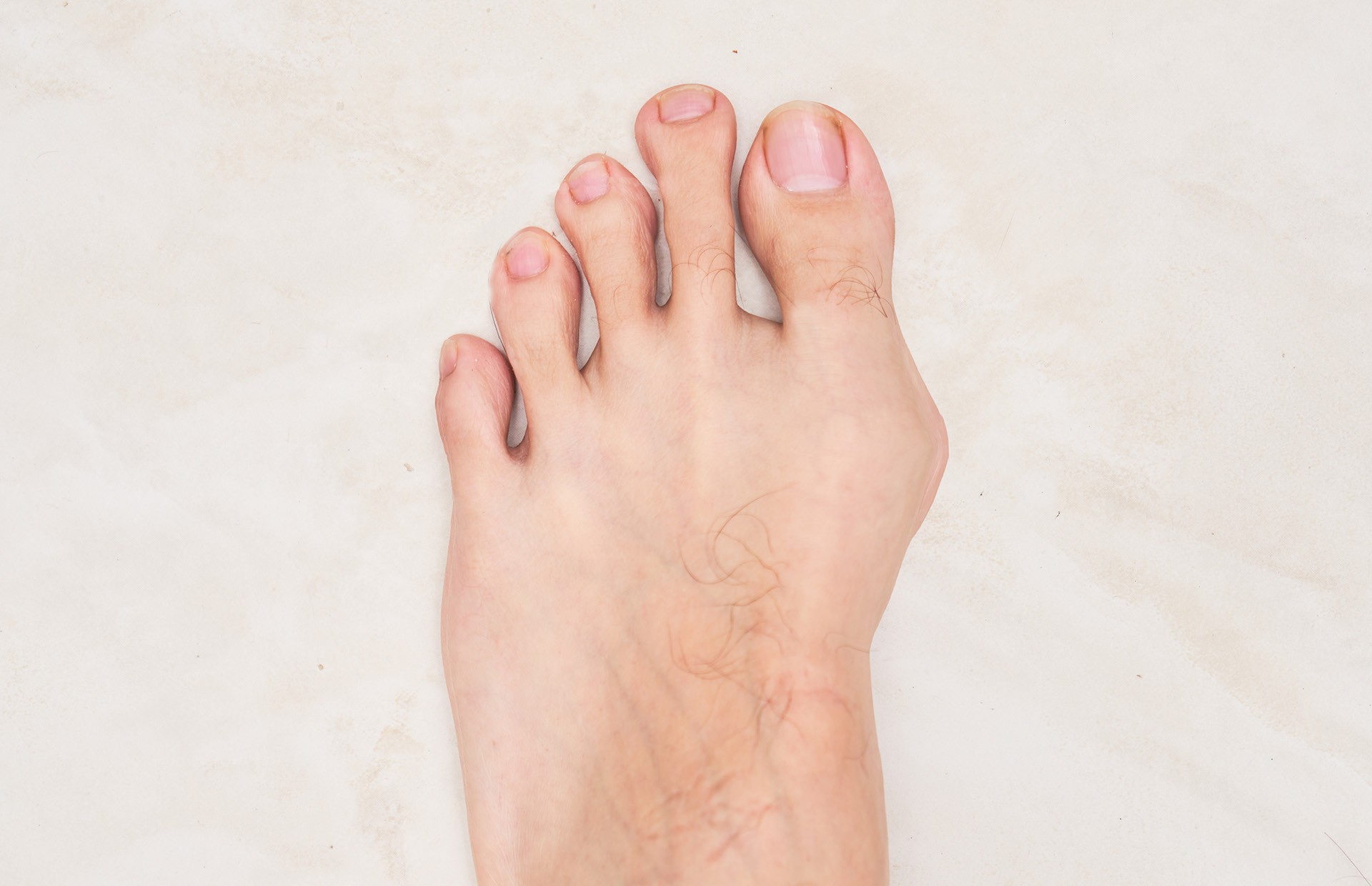 bunion pain on outside of foot