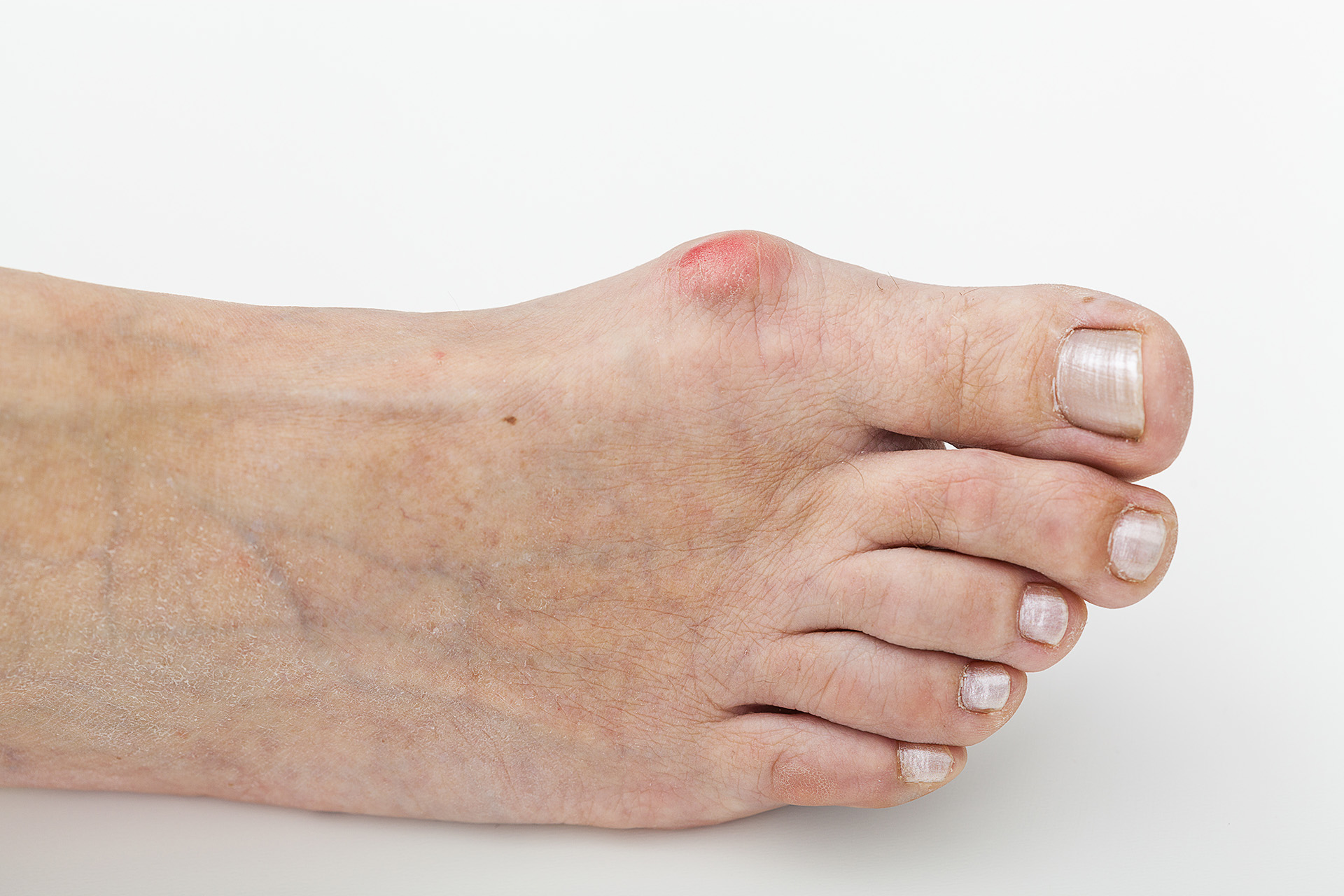 bunion pain symptoms