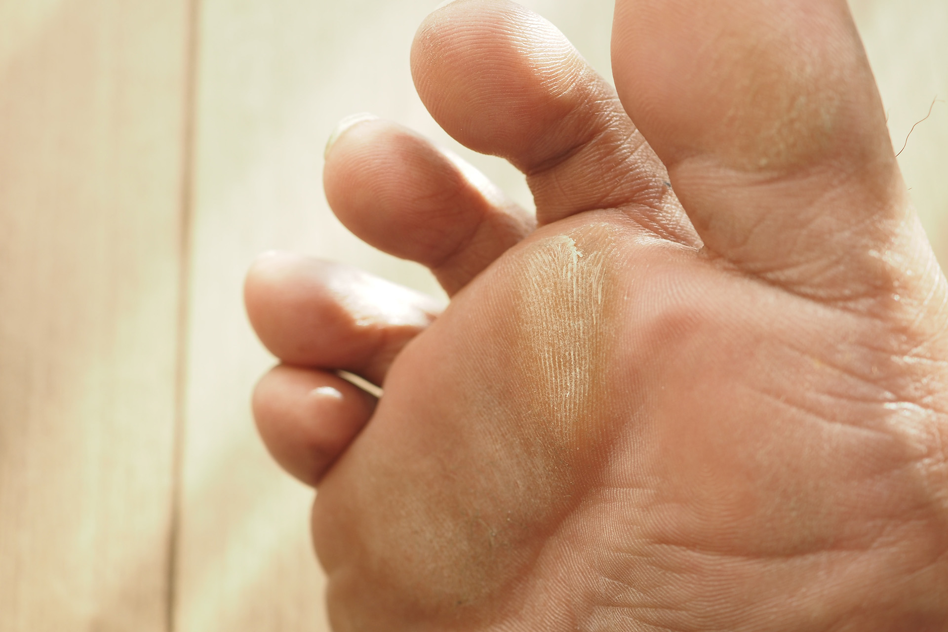 callus feet