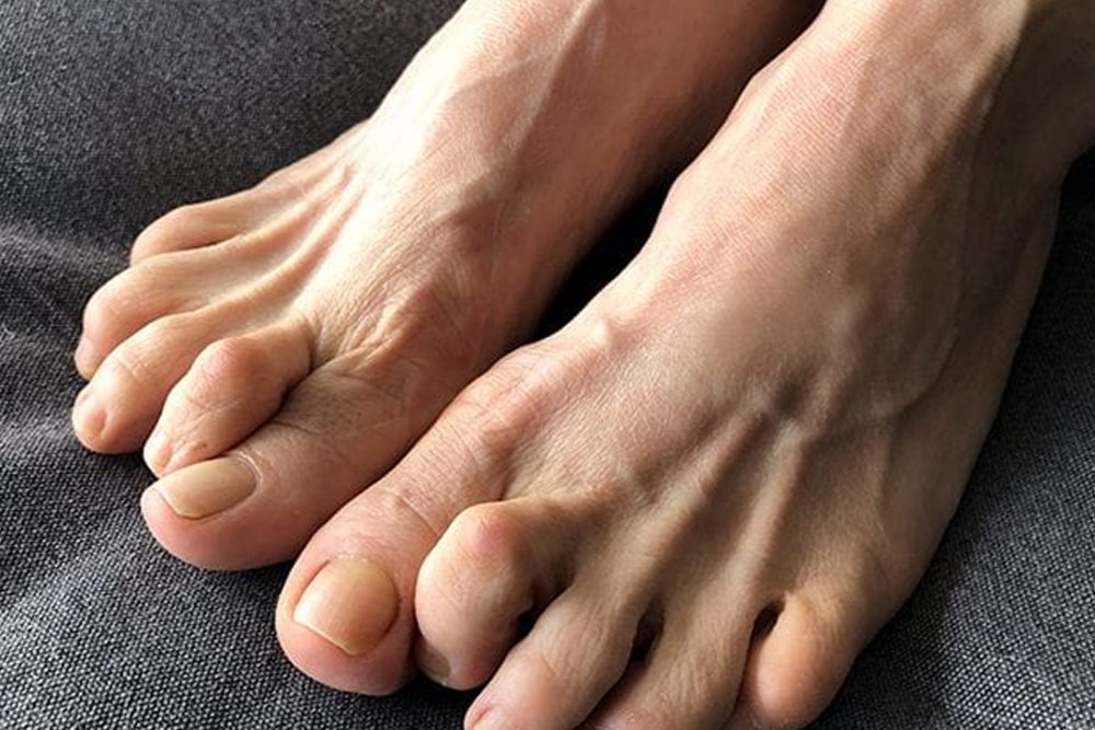 Claw Toe Treatment & Claw Foot The Foot Practice Singapore