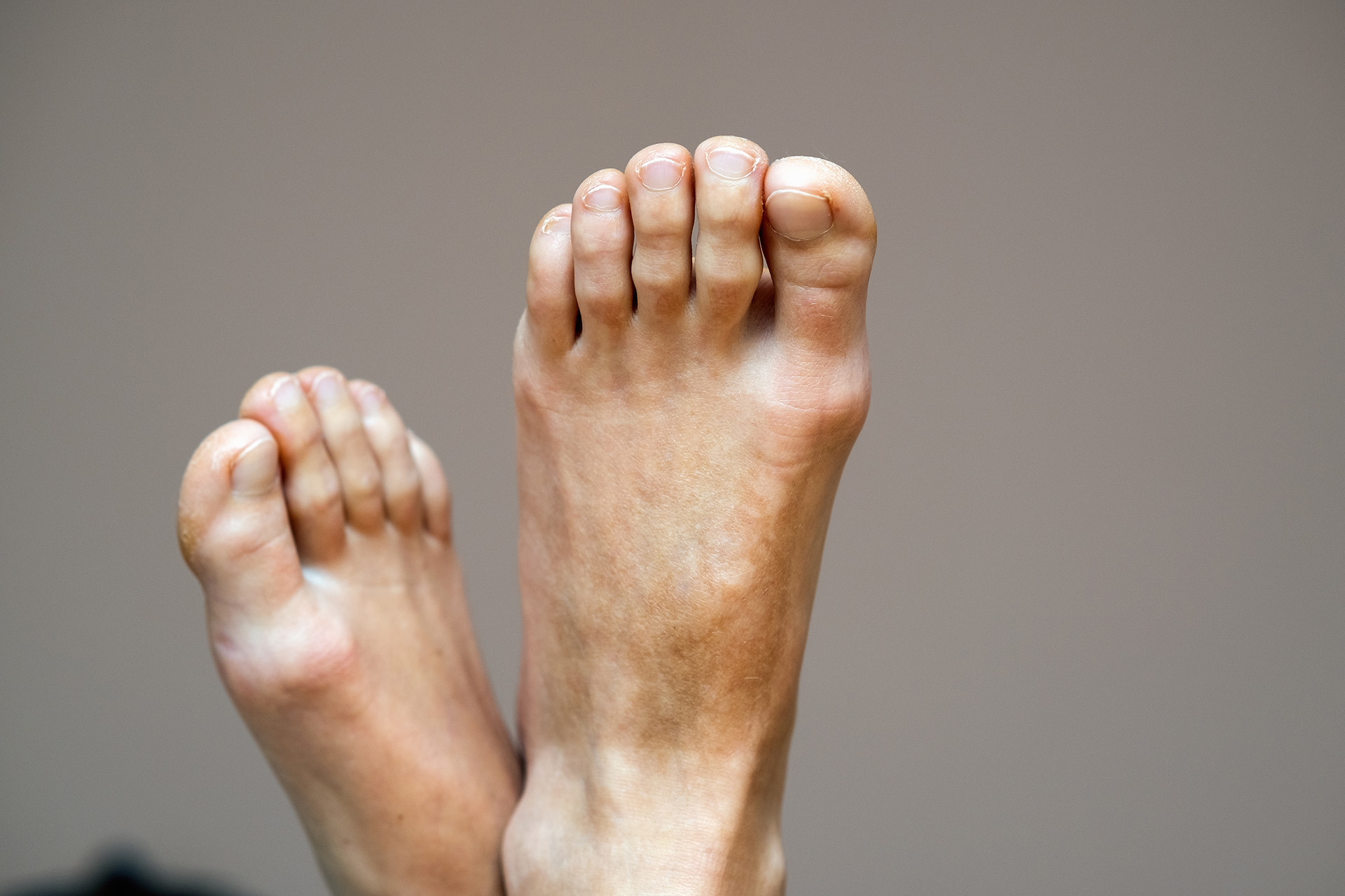 clawing of the toes