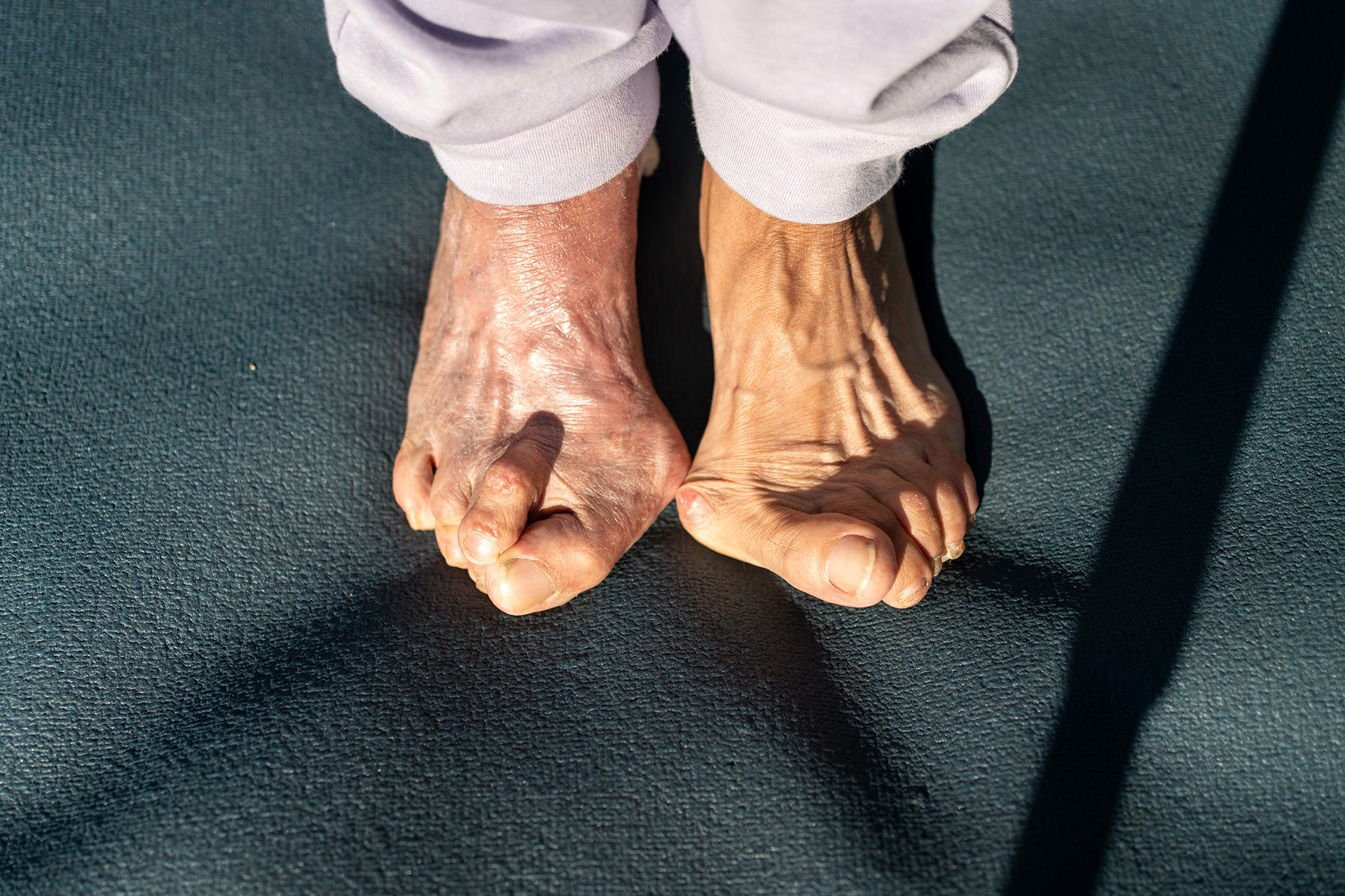 clawing of toes