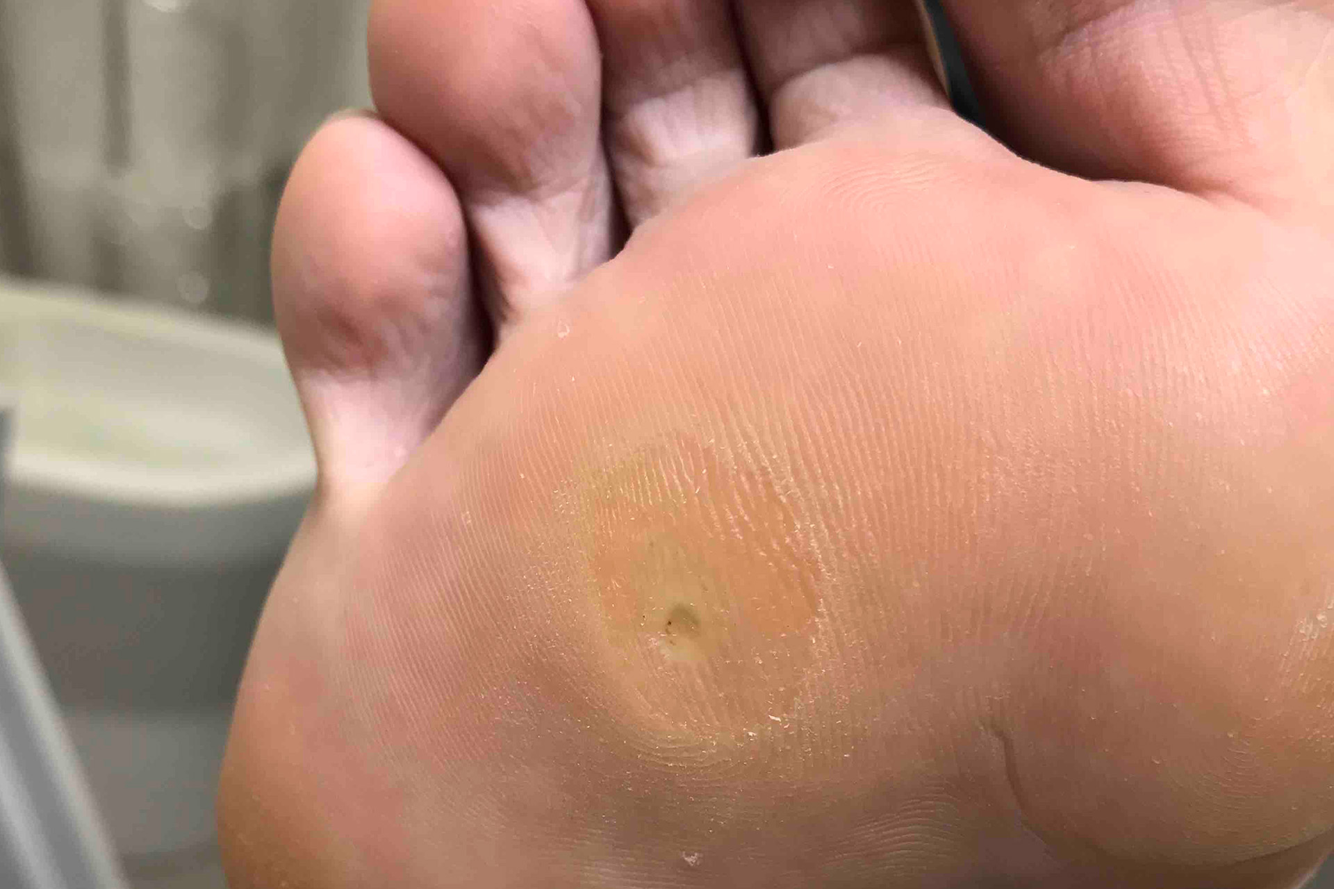 corn removal cost podiatrist Singapore