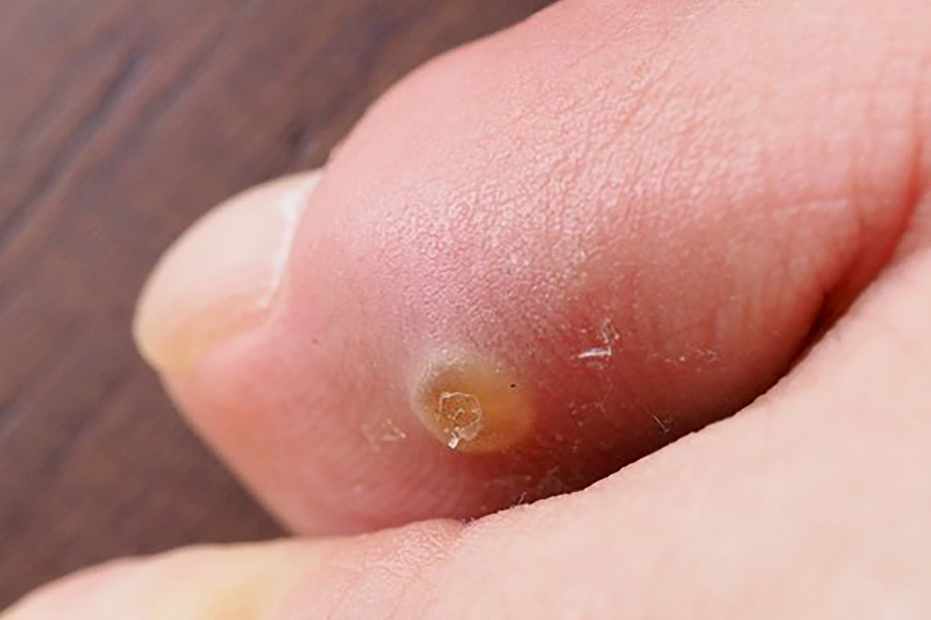 corns and calluses on feet