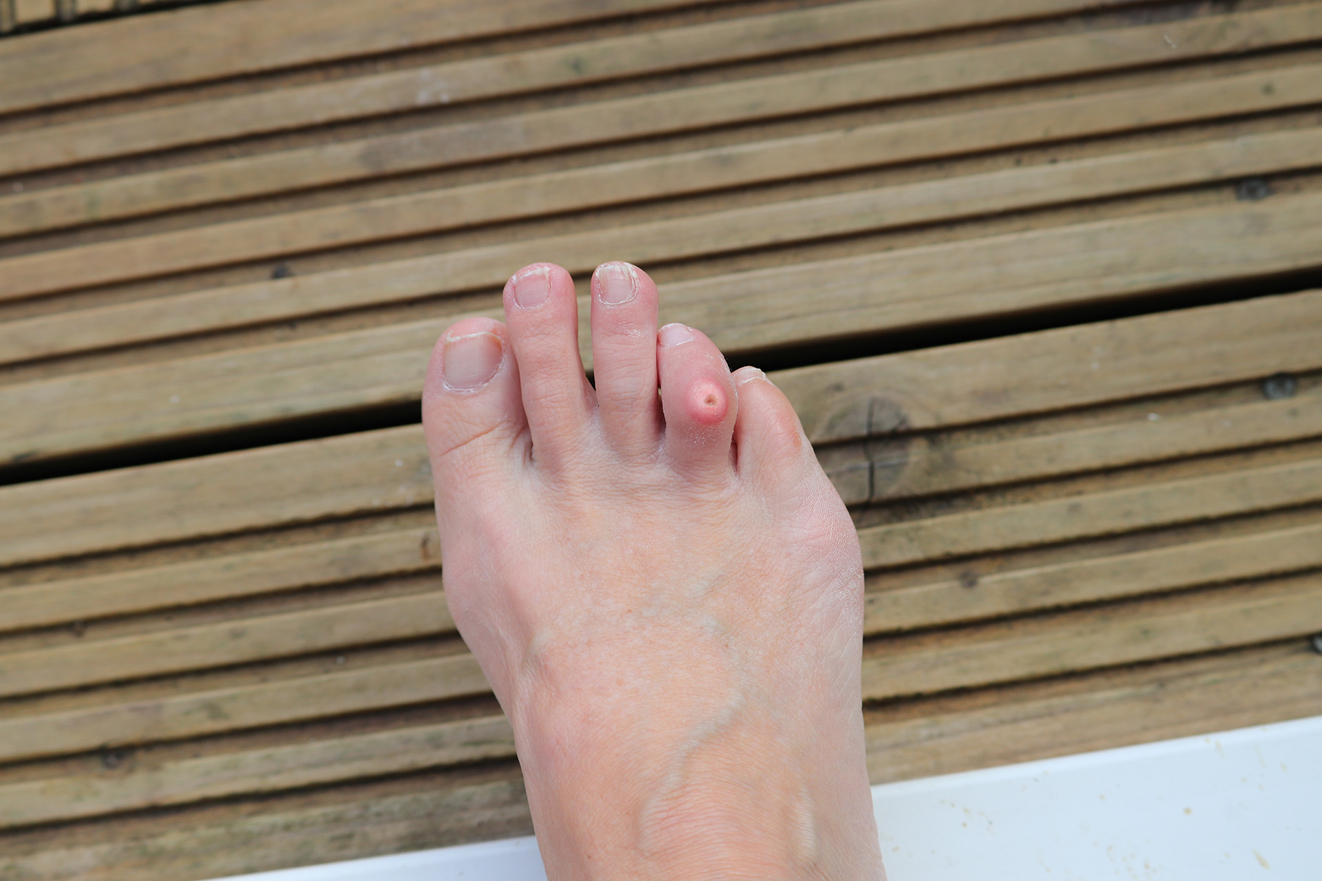 corns on feet