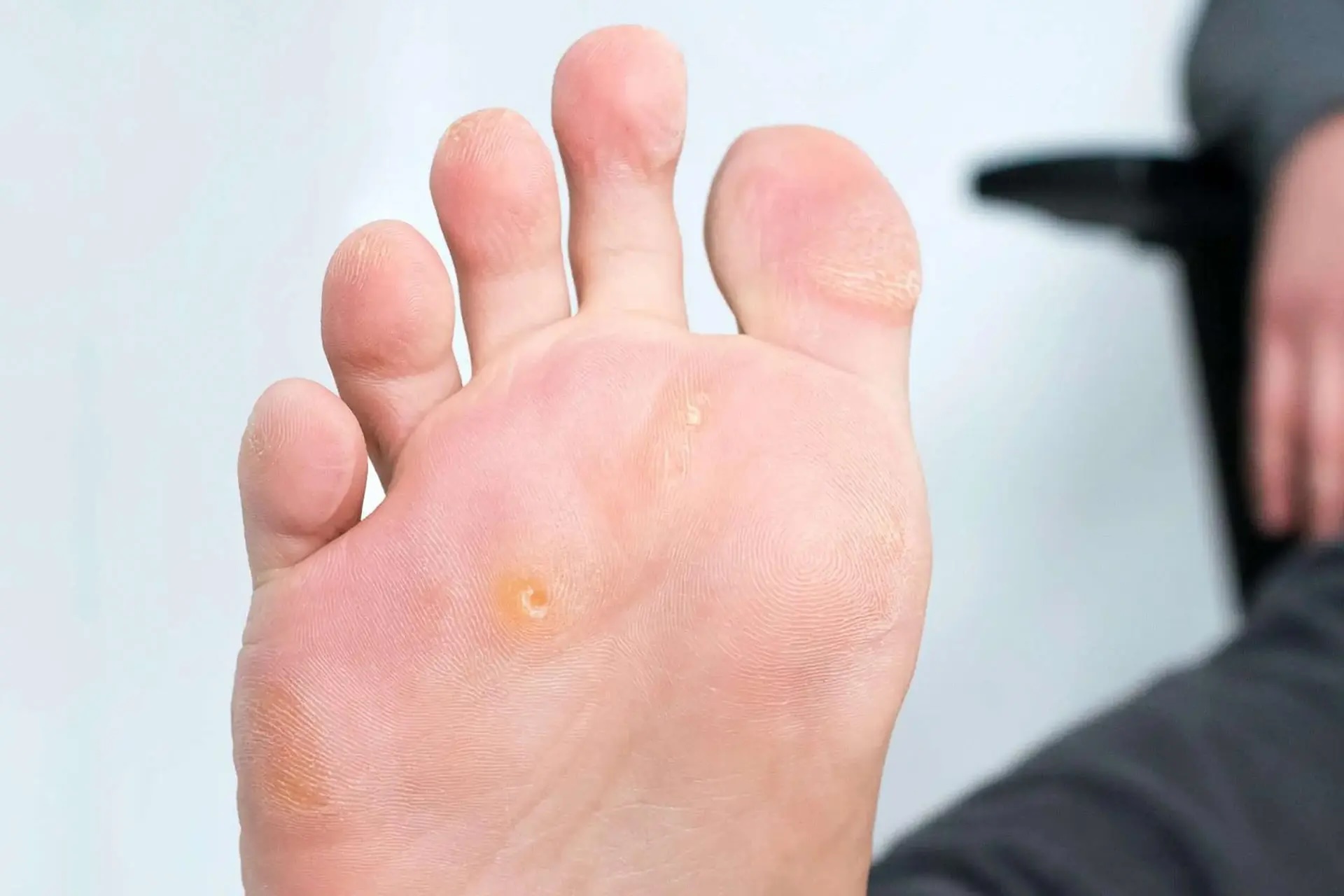 cure for corns on feet