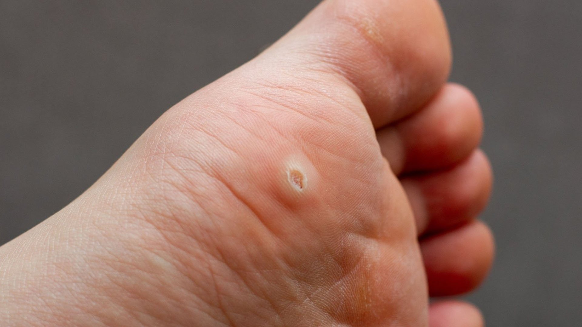 Treat Verruca Plantar Warts Remedy By The Foot Practice Podiatrist