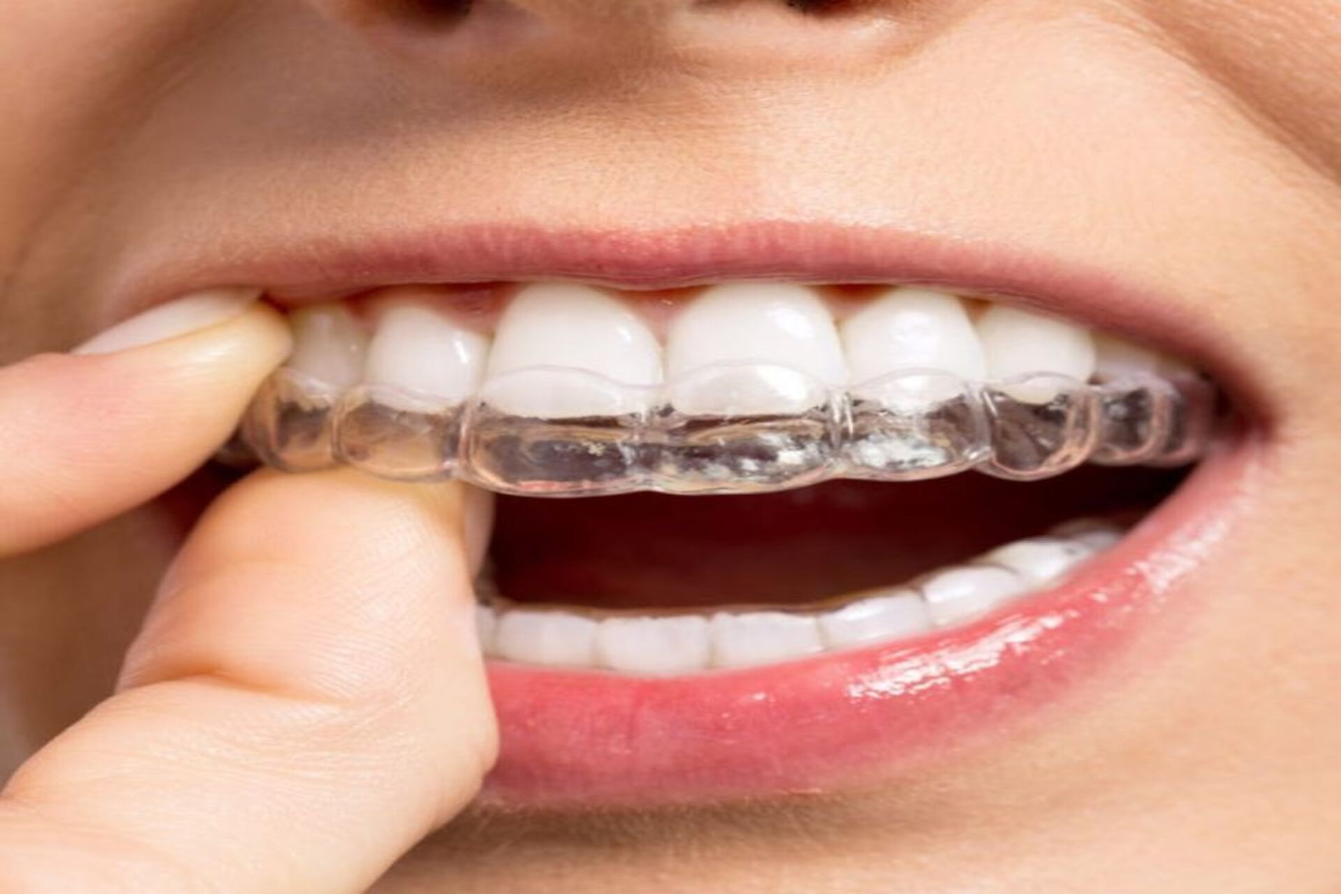 teenagers should wear a mouthguard to protect their mouth and keep their teeth healthy. 