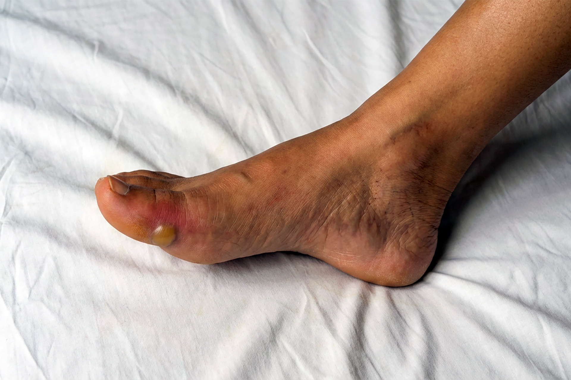 diabetic foot blister