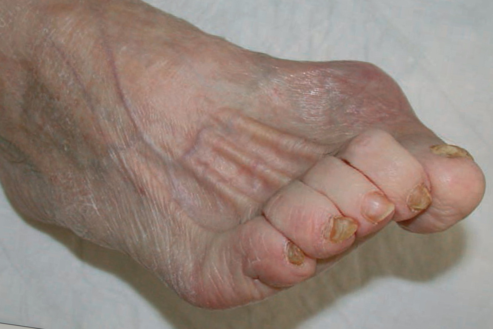 diabetic foot infection Charcot neuropathy