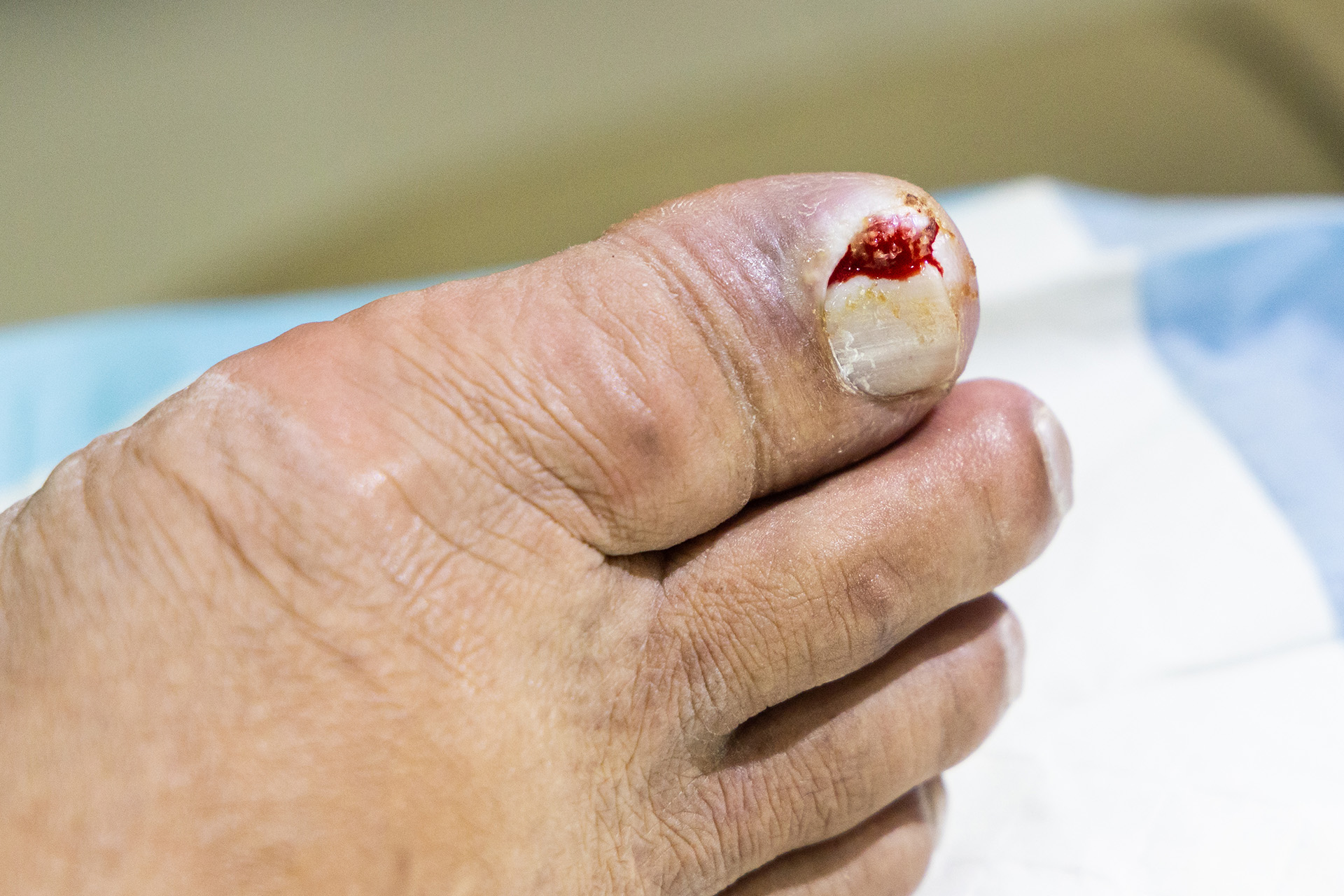 diabetic foot nail infection symptoms