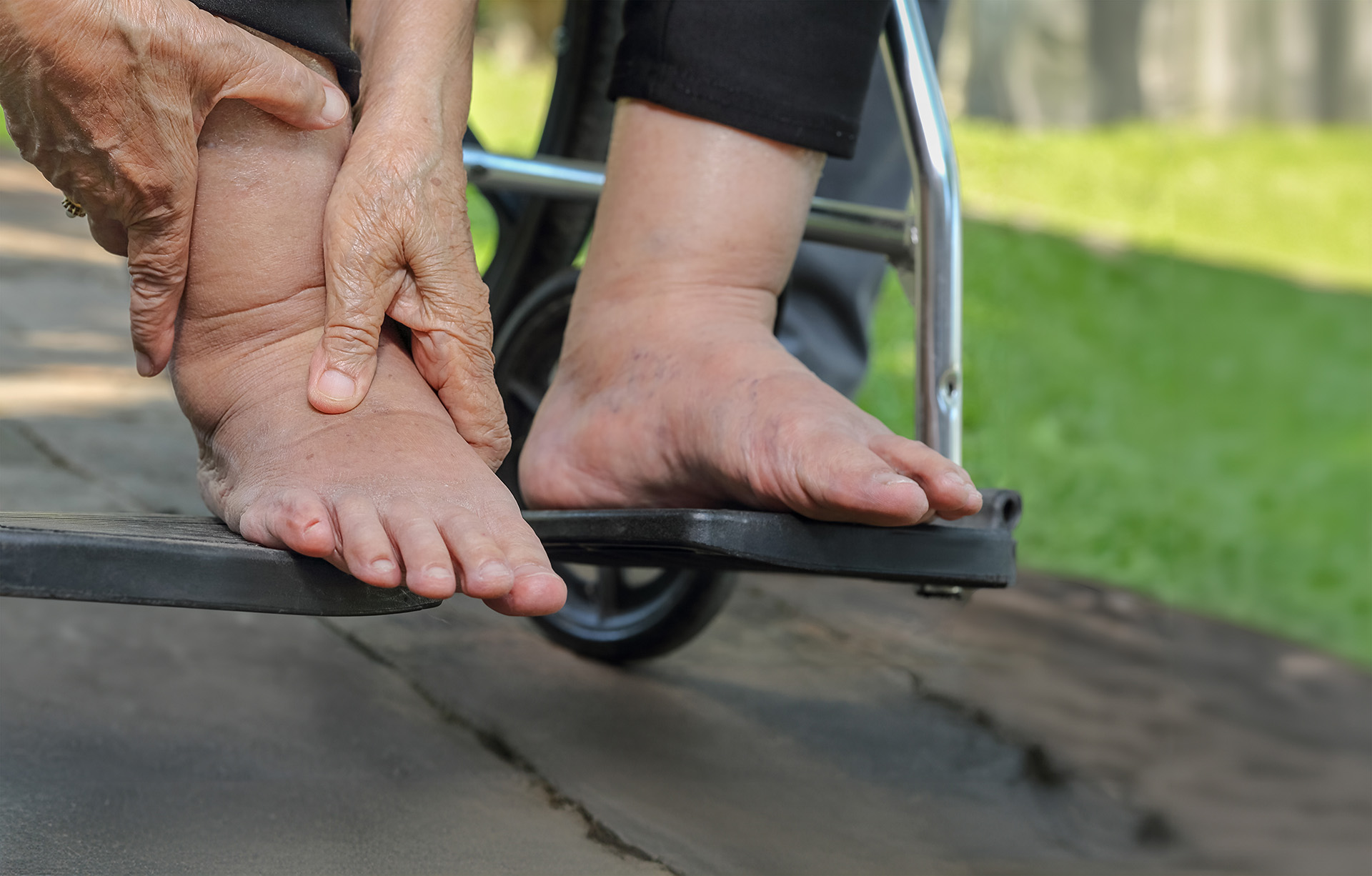 diabetic foot ulcer causes