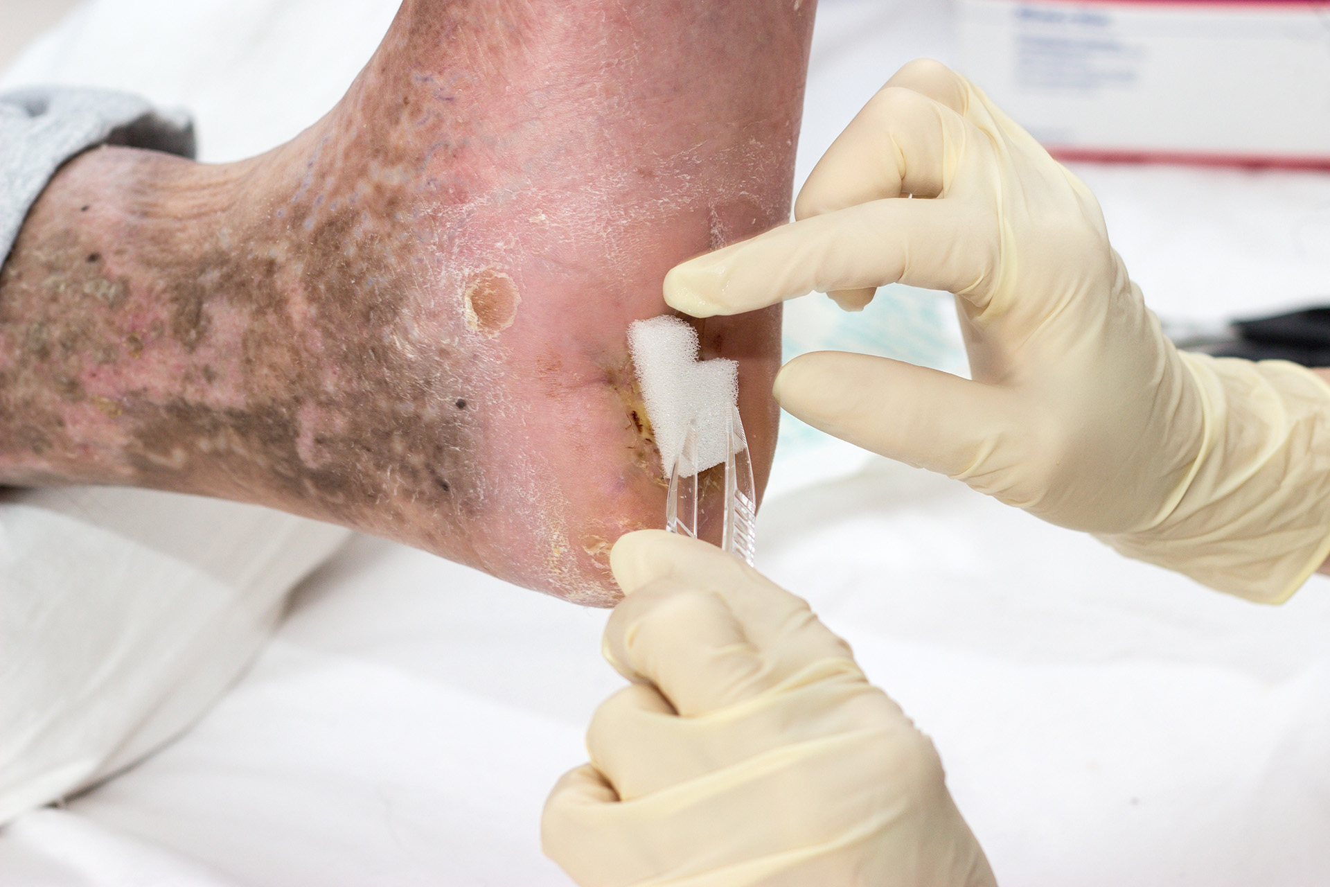 diabetic foot ulcer management