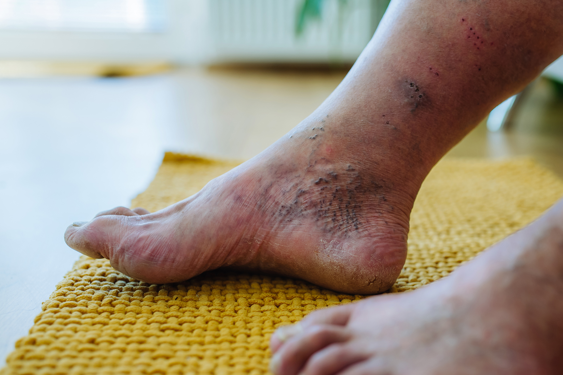 early-stage diabetic foot ulcer