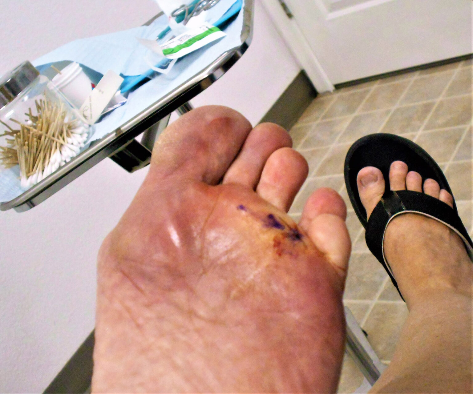 early-stage diabetic foot ulcer