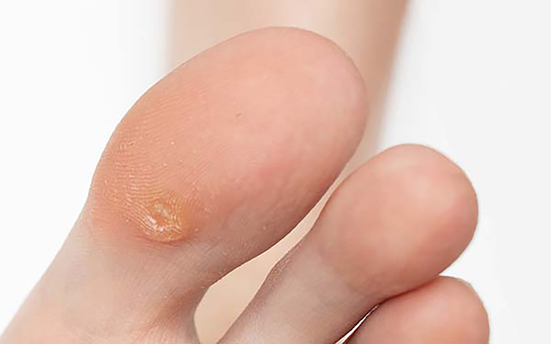 feet callus and corn