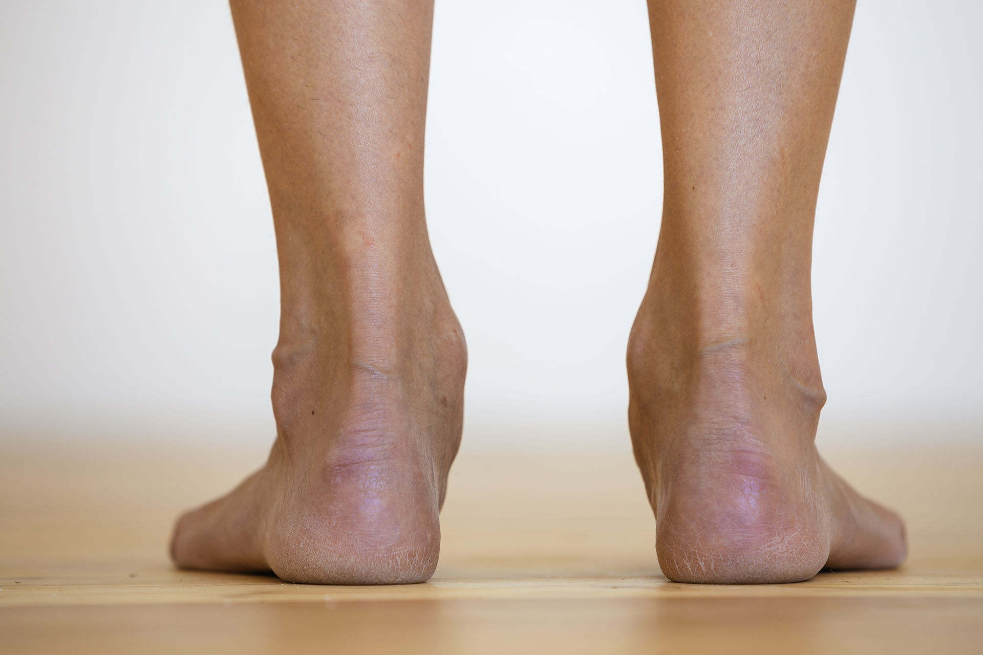 flat feet overpronation