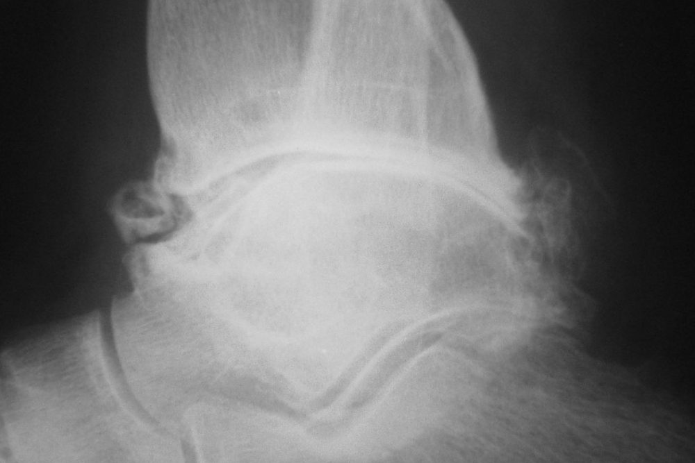 Living with Ankle Arthritis & Foot Pain The Foot Practice Podiatry Clinic