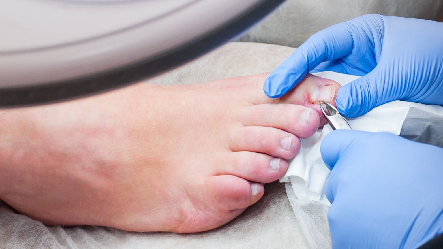 Ingrown Toenail Treatment The Foot Practice Podiatrist Singapore