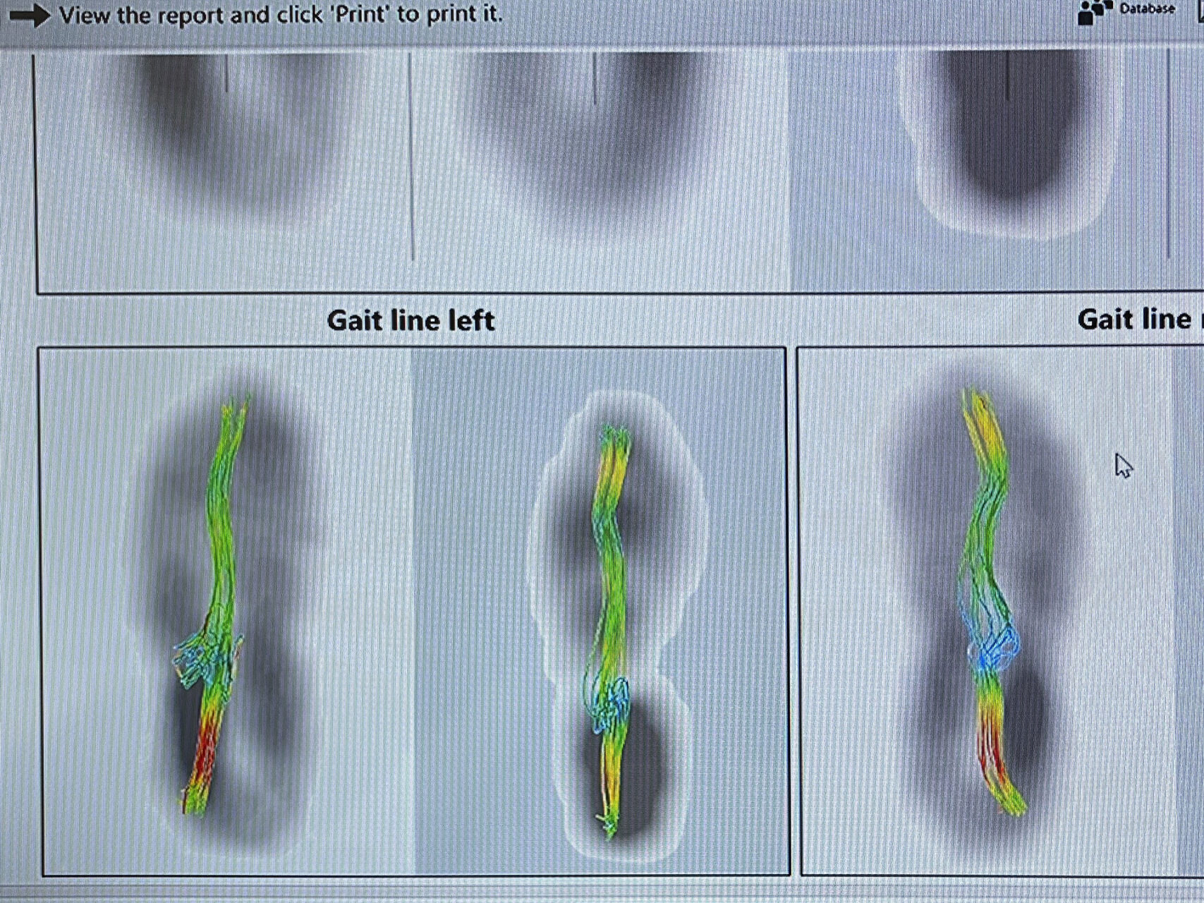 foot high arch pain
