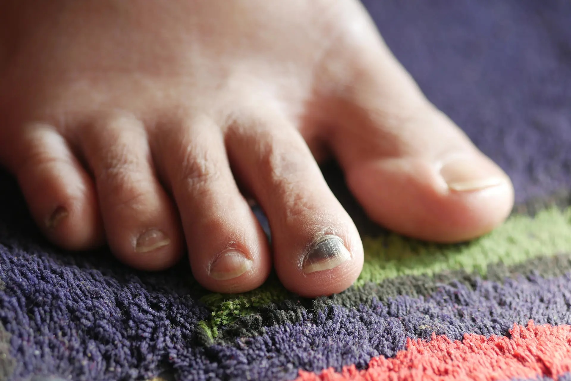 fungal infection under nail