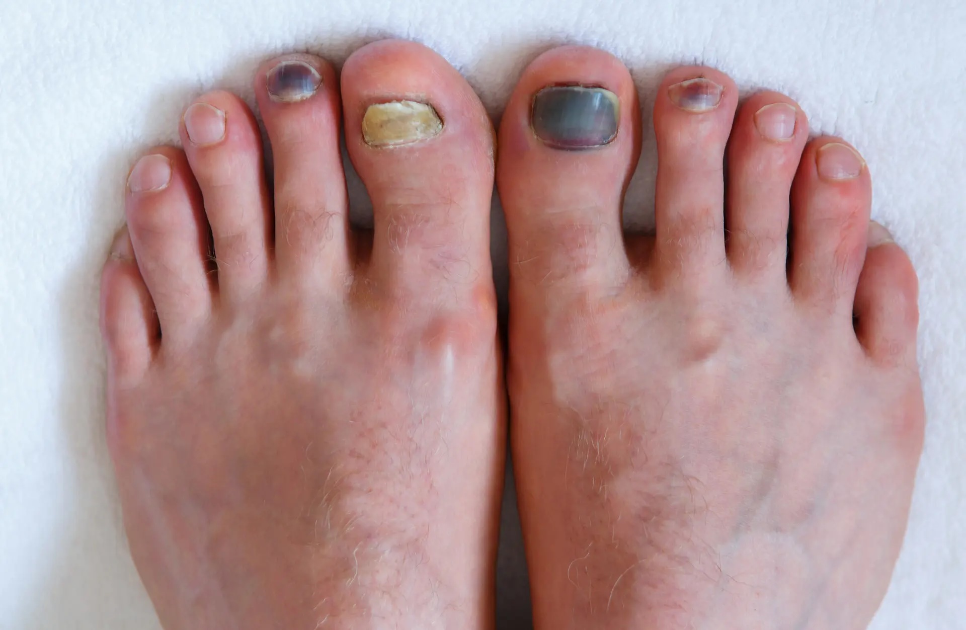 fungal nail infection Singapore