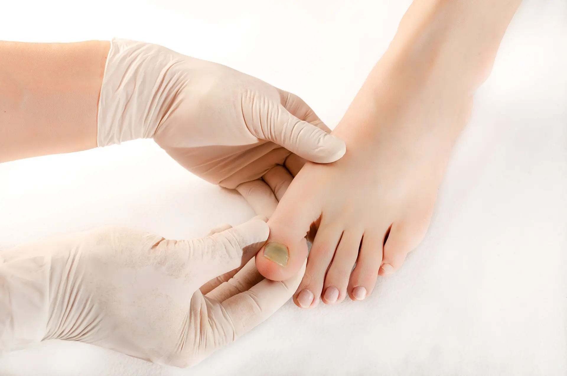 fungal nail infection causes