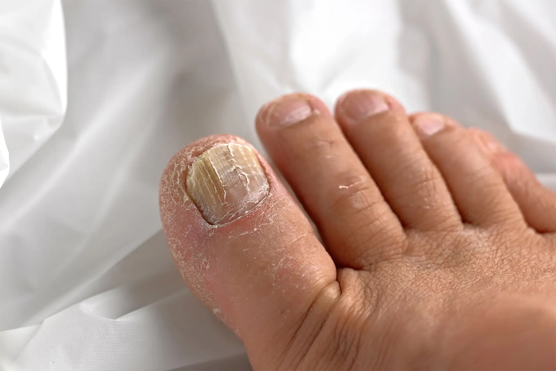 fungal nail infection in Singapore