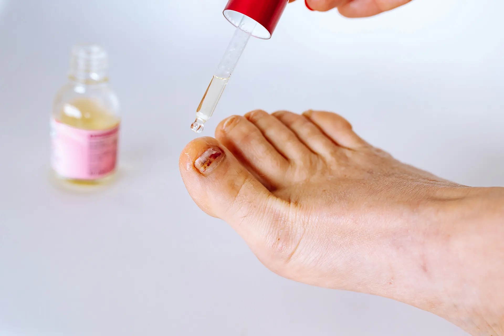 fungal nail infection treatment Singapore