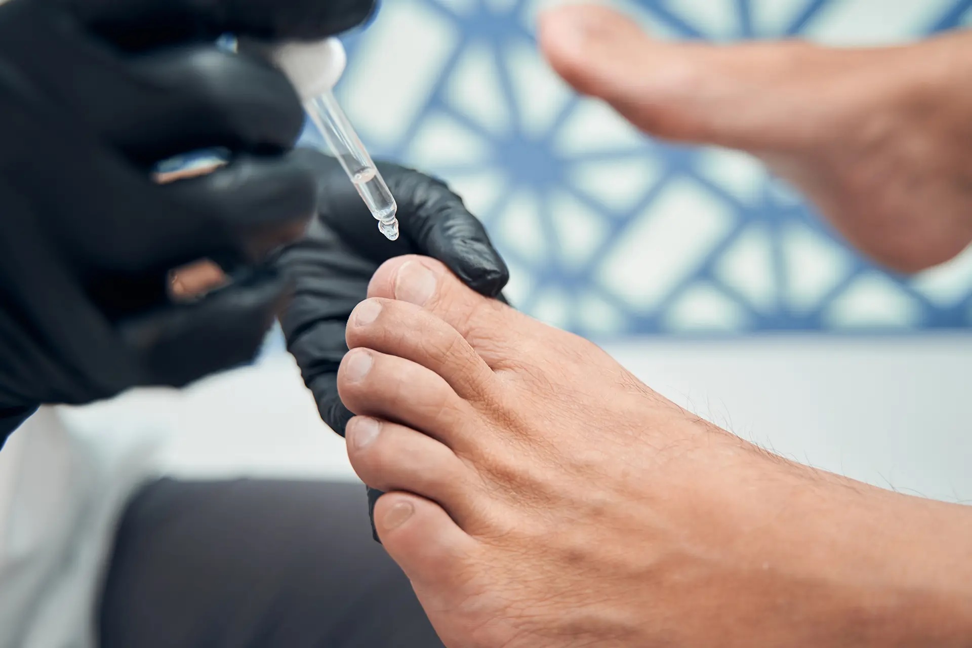 fungal nail infection treatment