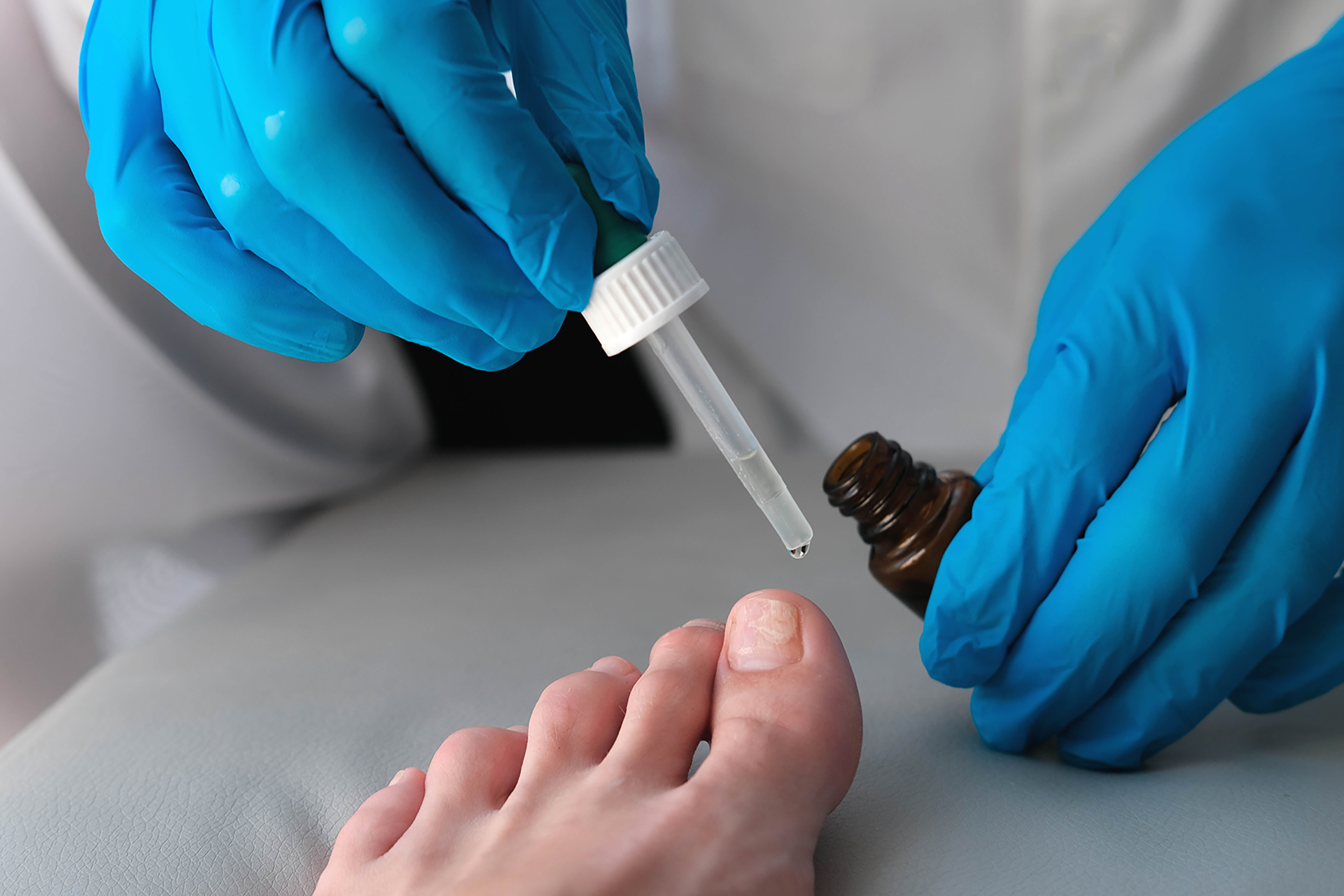 fungus-under-toenail-treatment