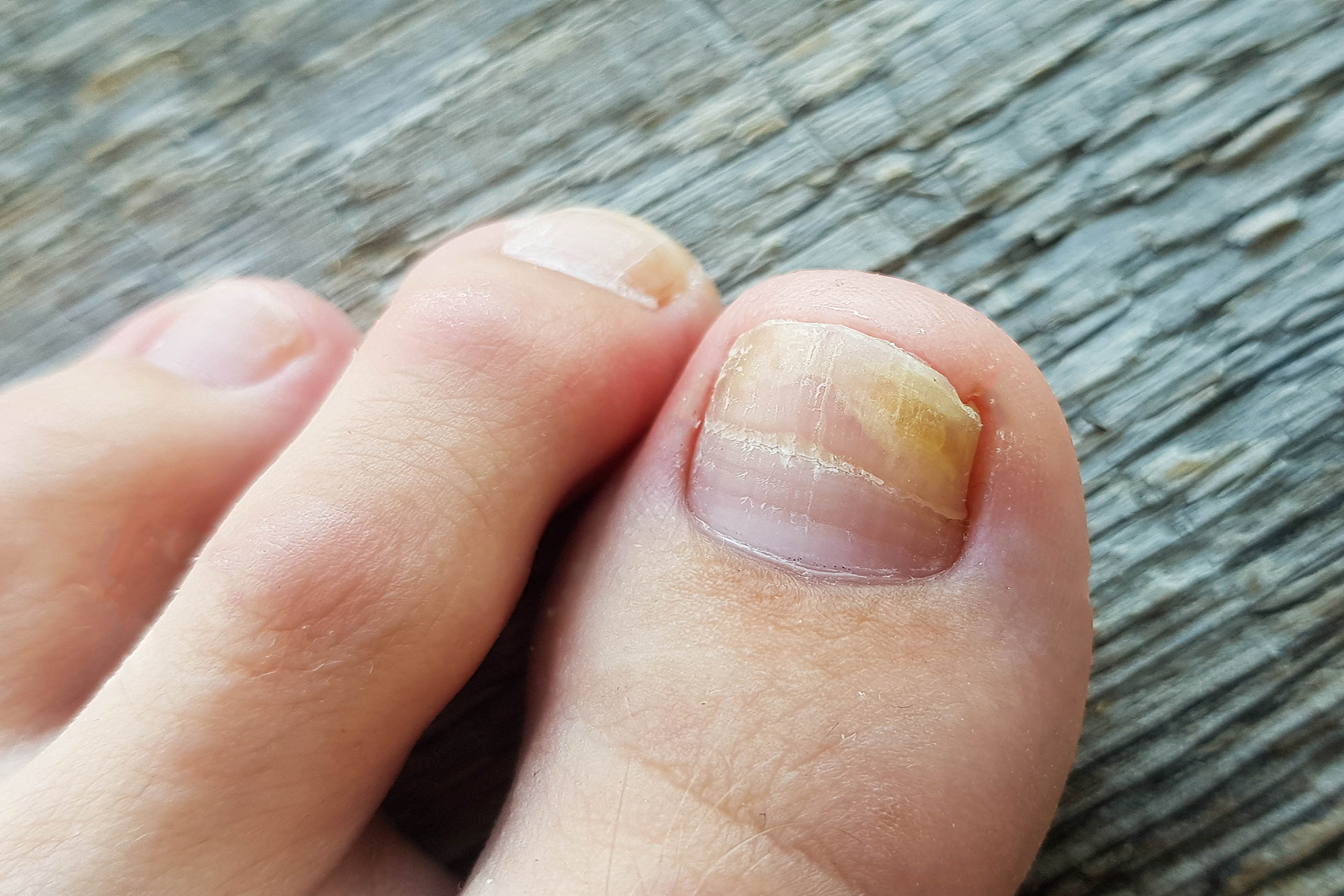 fungus-under-toenail