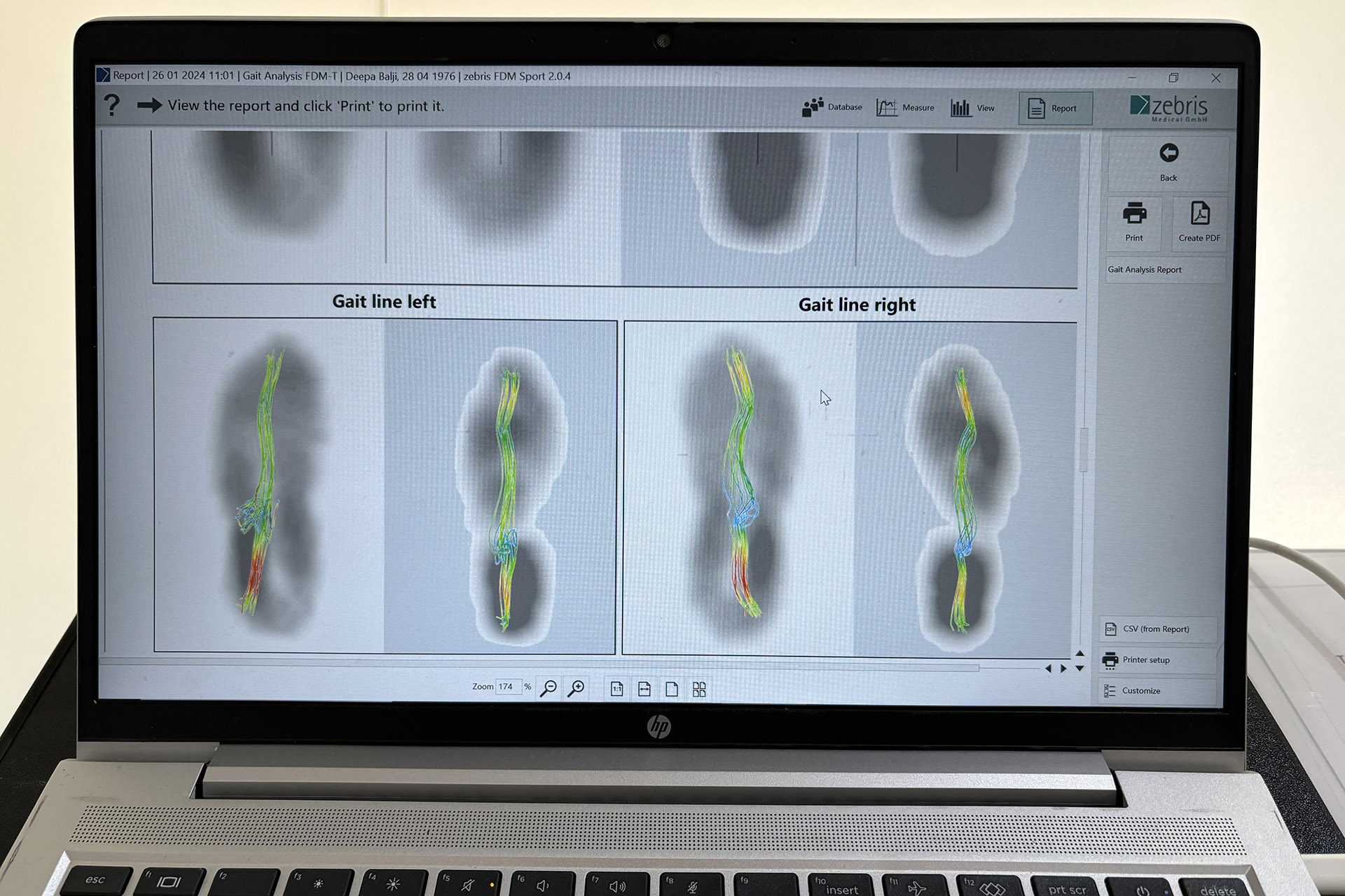 gait analysis to identify shin pain issues