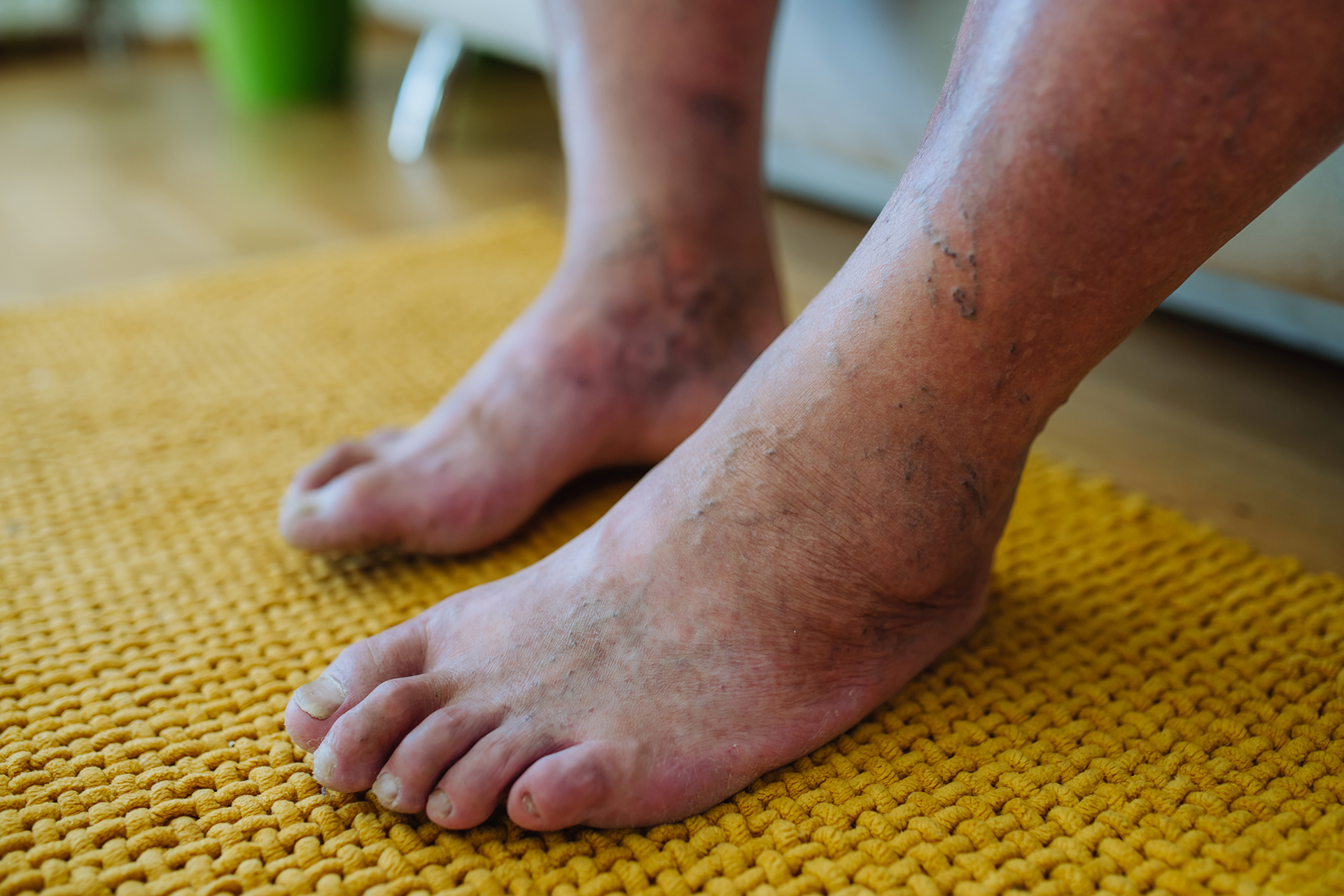 gout in ankle can't walk