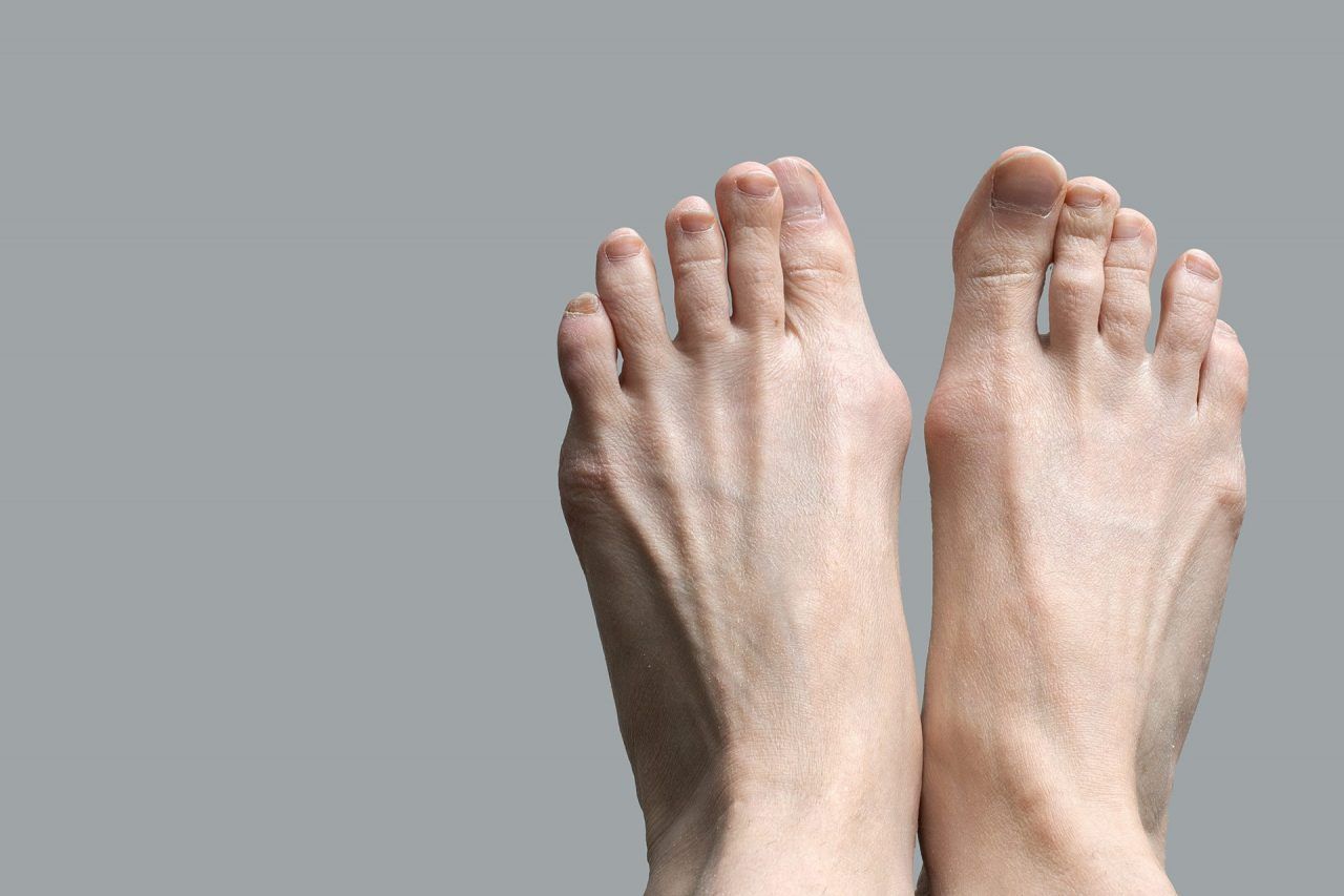 Guide Hallux Valgus & Hallux Valgus Treatments | The Foot Practice